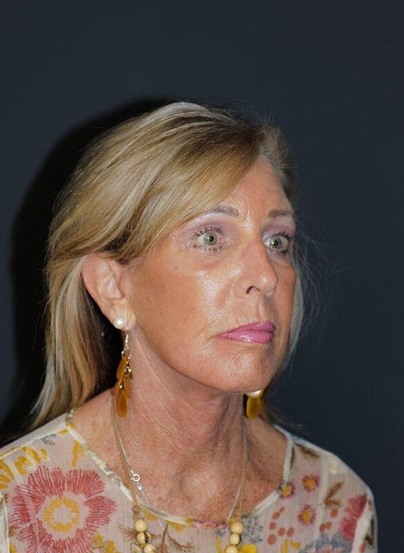 Facelift Neck Lift Before & After