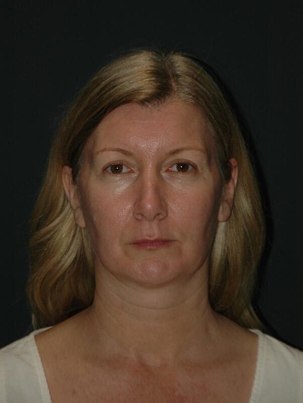 Facelift Neck Lift Before & After