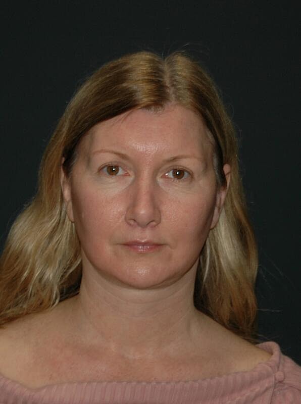 Facelift Neck Lift Before & After