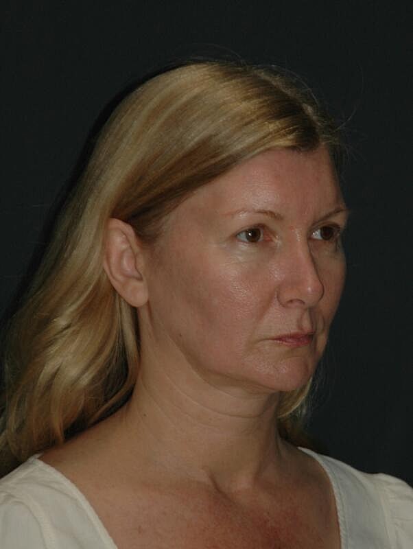 Facelift Neck Lift Before & After
