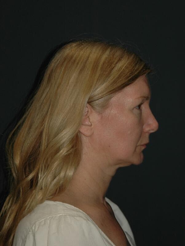 Facelift Neck Lift Before & After
