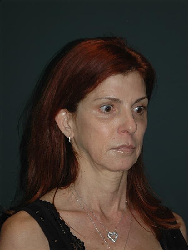 Facelift Neck Lift Before & After