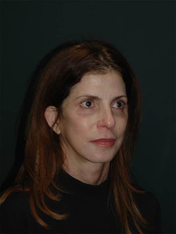 Facelift Neck Lift Before & After