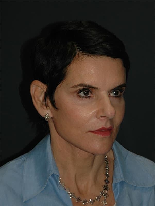 Facelift Neck Lift Before & After