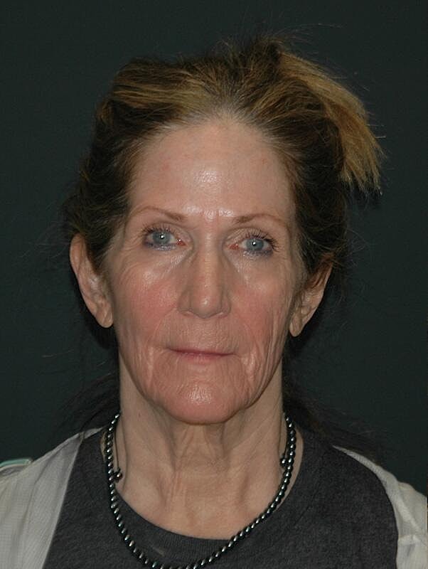 Facelift Neck Lift Before & After