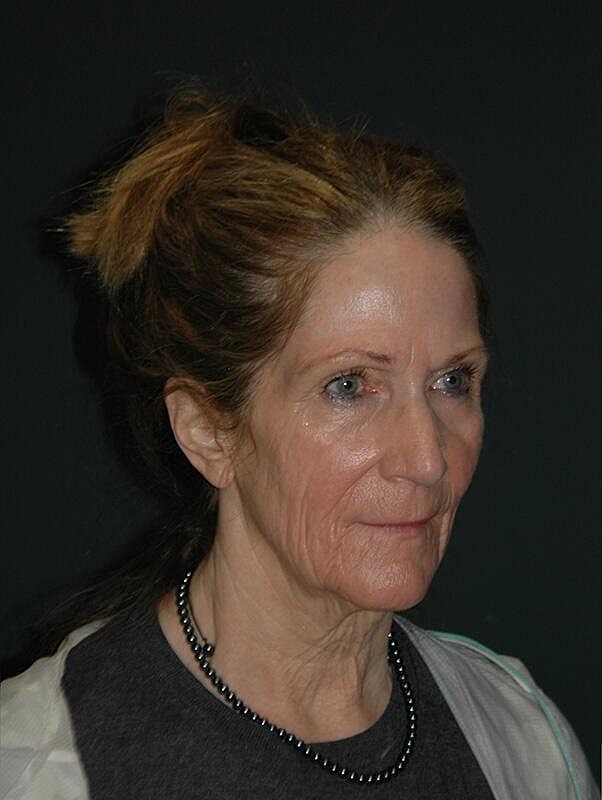 Facelift Neck Lift Before & After