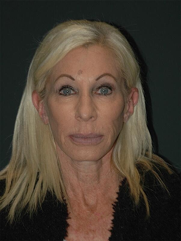 Facelift Neck Lift Before & After