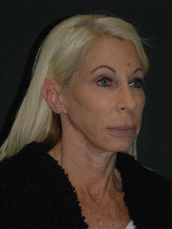 Facelift Neck Lift Before & After
