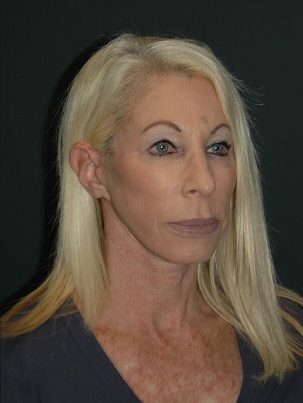 Facelift Neck Lift Before & After
