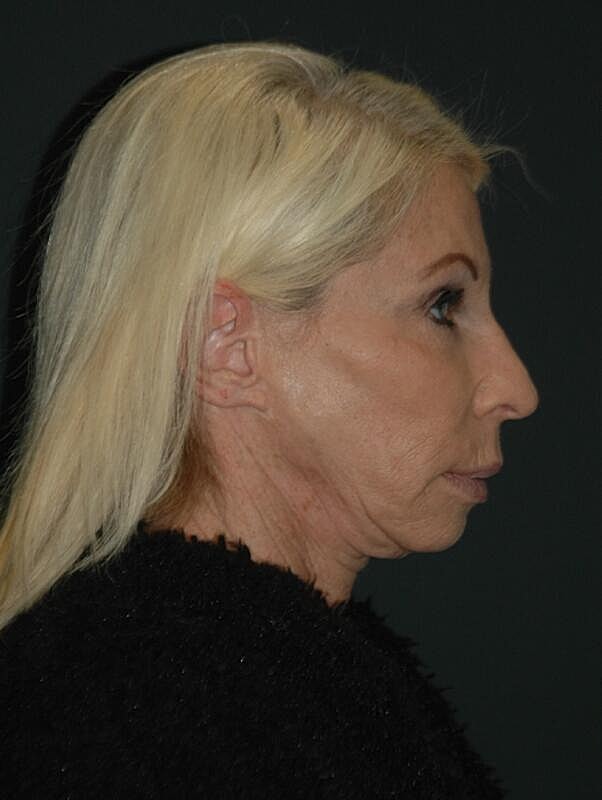 Facelift Neck Lift Before & After