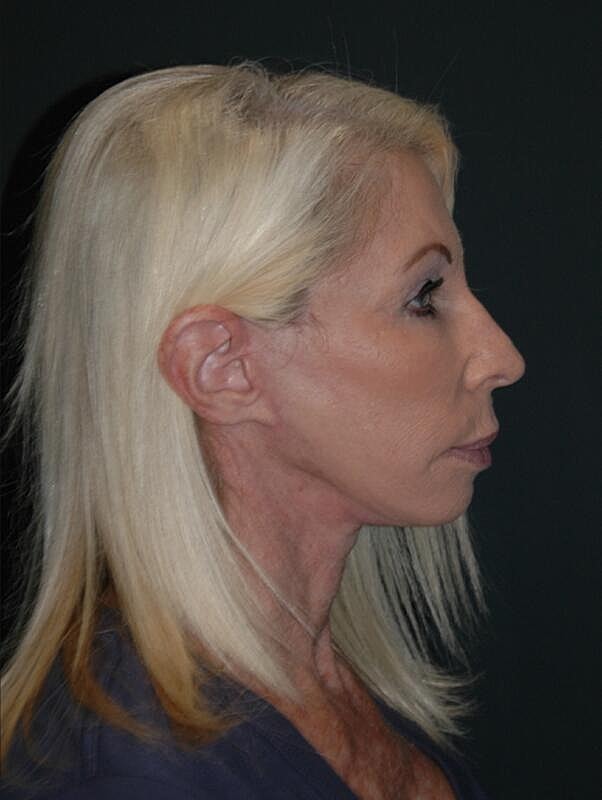 Facelift Neck Lift Before & After