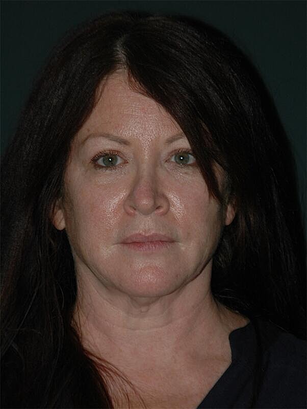 Facelift Neck Lift Before & After