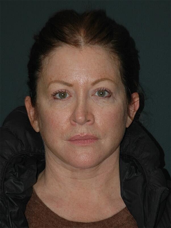 Facelift Neck Lift Before & After