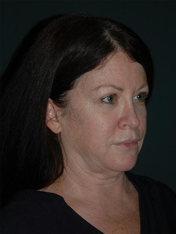 Facelift Neck Lift Before & After