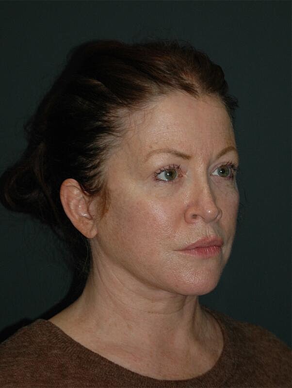 Facelift Neck Lift Before & After