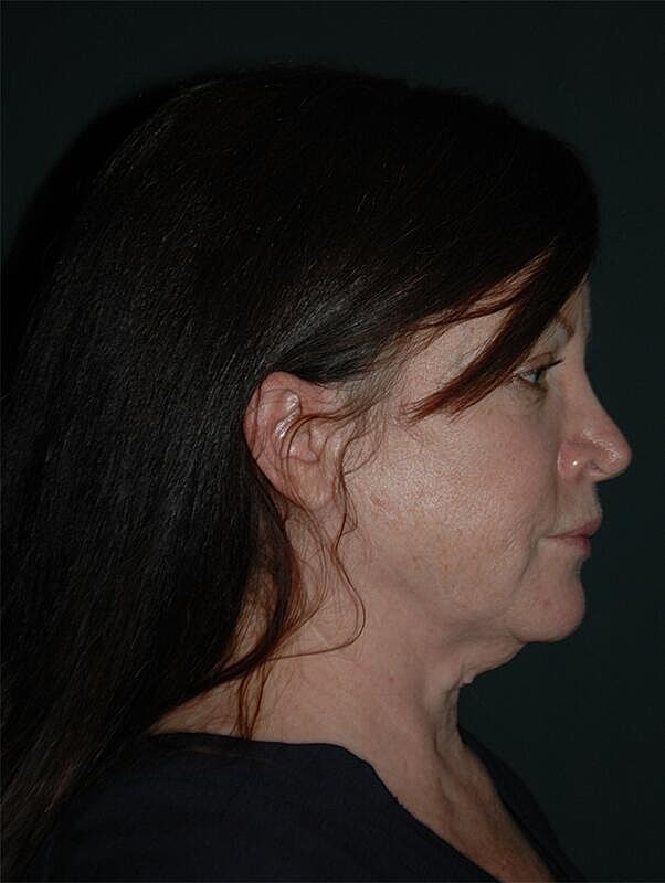 Facelift Neck Lift Before & After