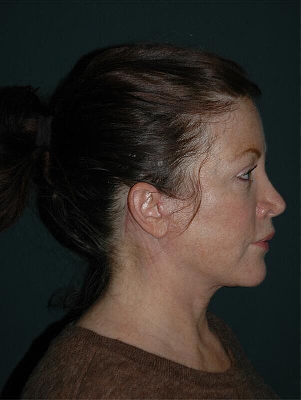 Facelift Neck Lift Before & After