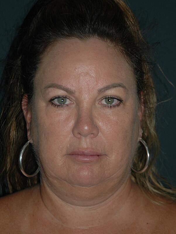 Facelift Neck Lift Before & After