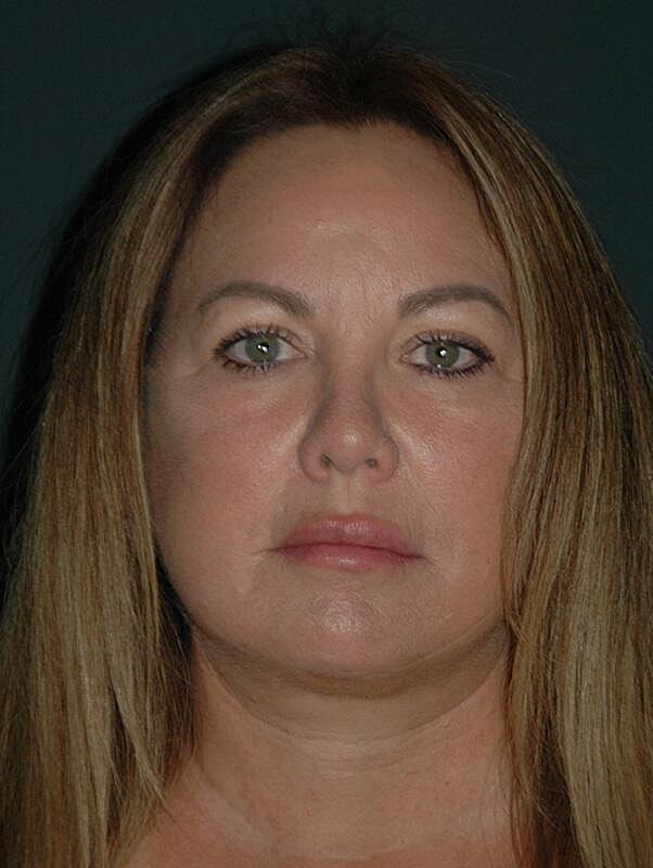 Facelift Neck Lift Before & After