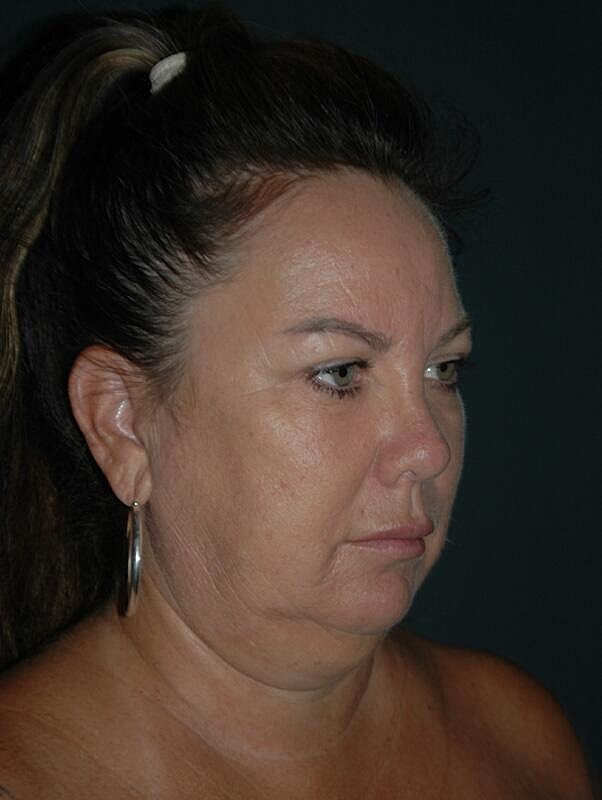 Facelift Neck Lift Before & After