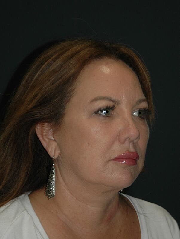 Facelift Neck Lift Before & After