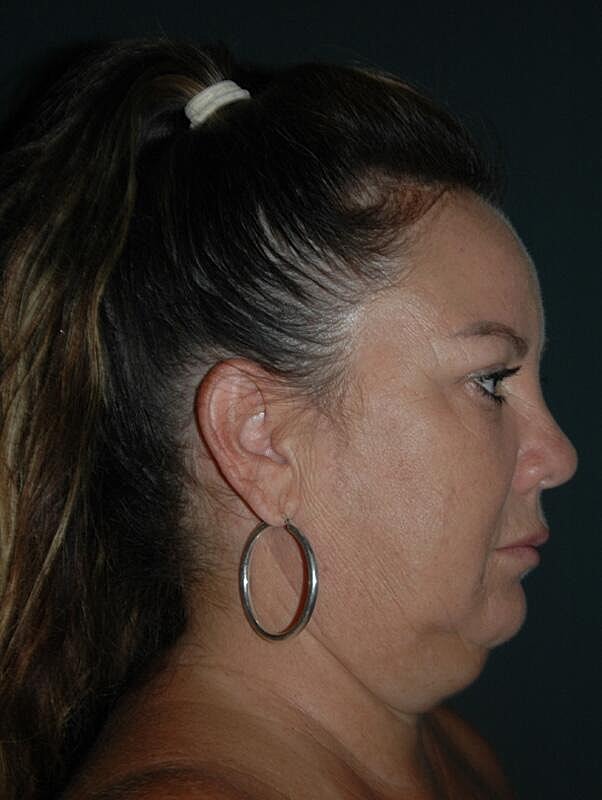 Facelift Neck Lift Before & After