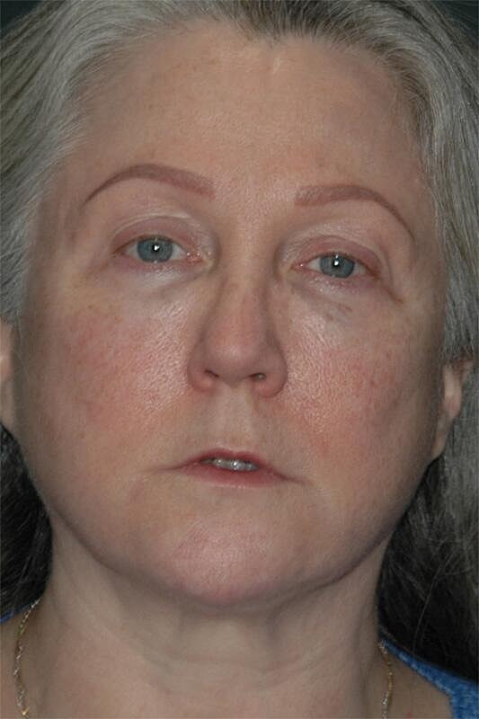 Facelift Neck Lift Before & After