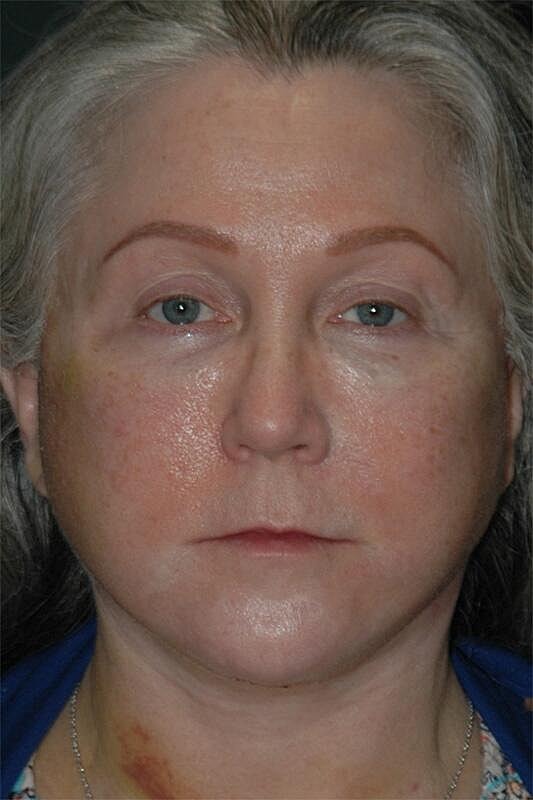 Facelift Neck Lift Before & After