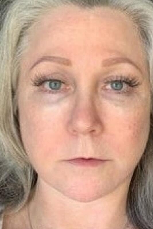 Facelift Neck Lift Before & After