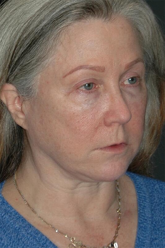Facelift Neck Lift Before & After