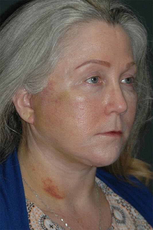 Facelift Neck Lift Before & After