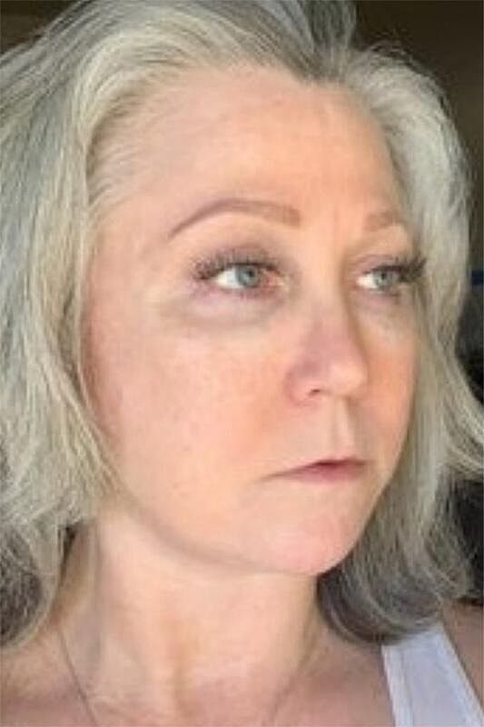 Facelift Neck Lift Before & After