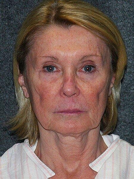 Facelift Neck Lift Before & After