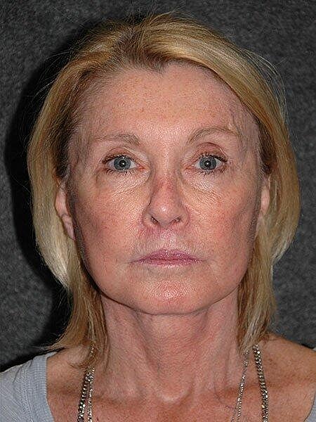 Facelift Neck Lift Before & After