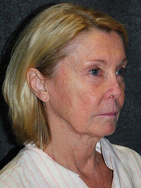 Facelift Neck Lift Before & After