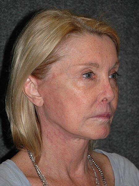 Facelift Neck Lift Before & After