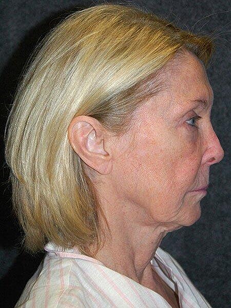 Facelift Neck Lift Before & After