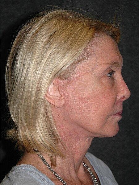 Facelift Neck Lift Before & After