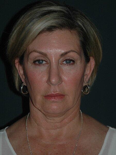 Facelift Neck Lift Before & After