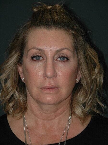 Facelift Neck Lift Before & After