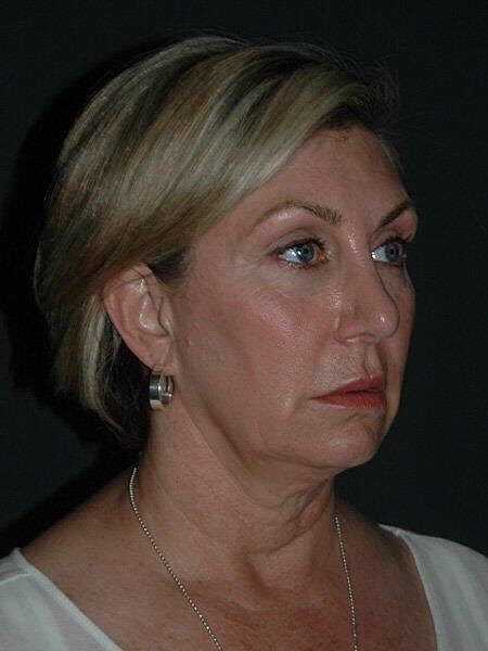 Facelift Neck Lift Before & After