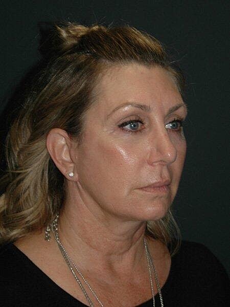 Facelift Neck Lift Before & After