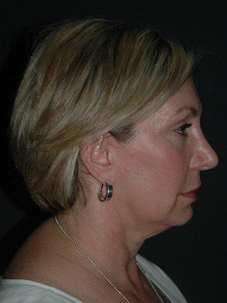 Facelift Neck Lift Before & After
