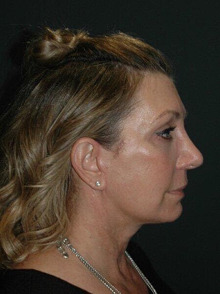 Facelift Neck Lift Before & After