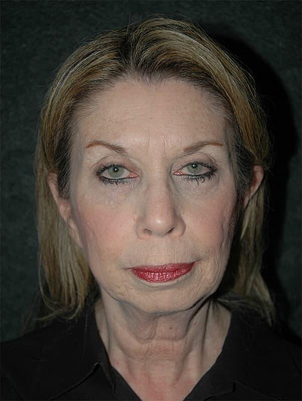Facelift Neck Lift Before & After