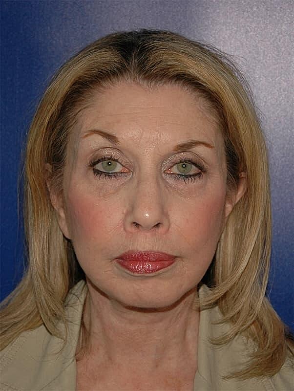 Facelift Neck Lift Before & After