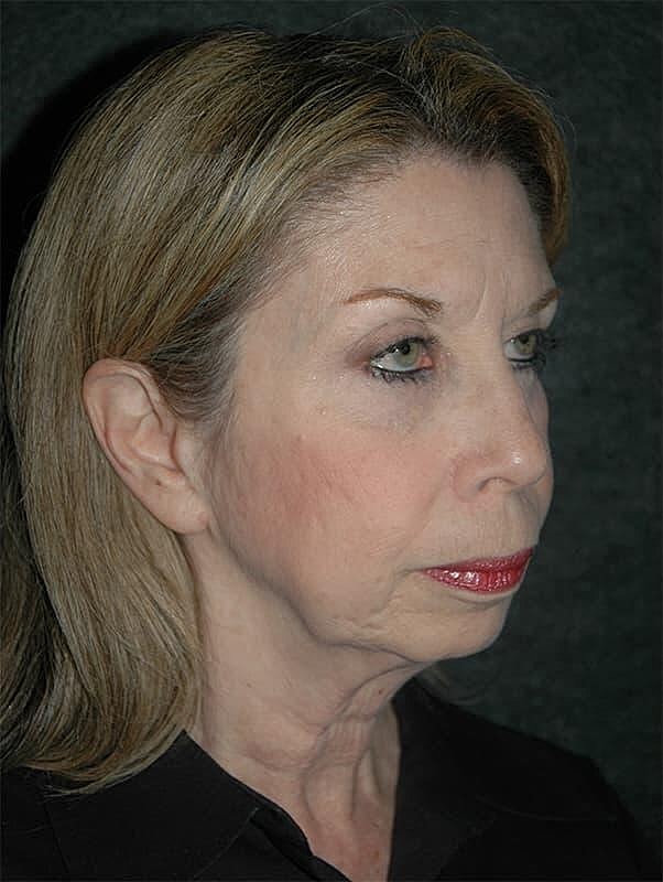 Facelift Neck Lift Before & After