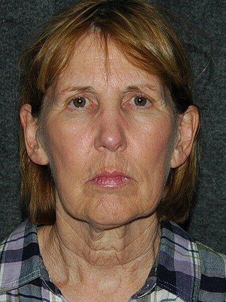 Facelift Neck Lift Before & After