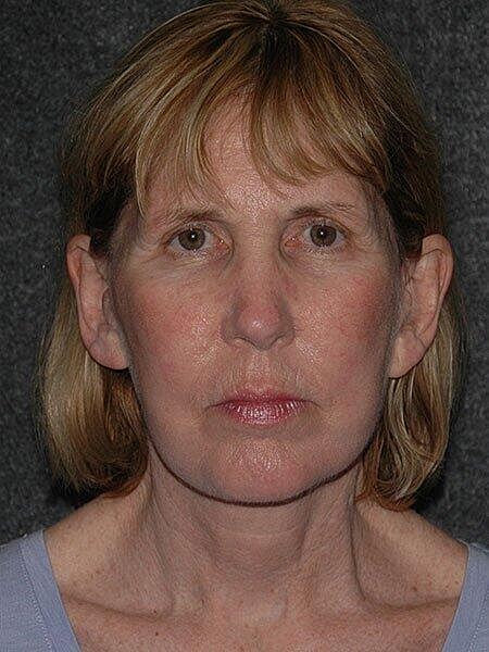 Facelift Neck Lift Before & After