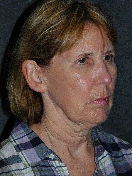 Facelift Neck Lift Before & After